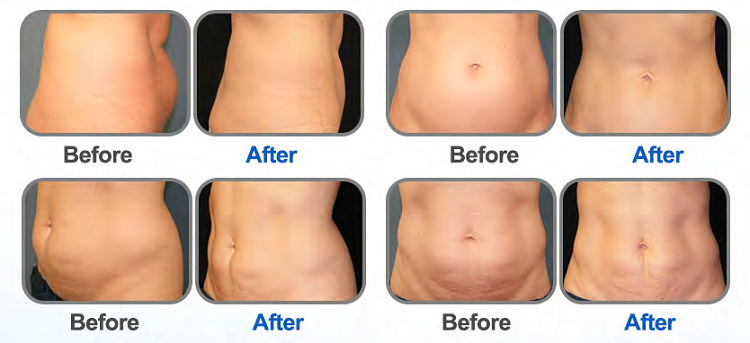 cryo body sculpting before and after
